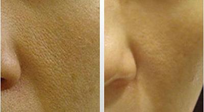 https://www.dermarollerstore.co.uk/wp-content/uploads/2016/02/derma-roller-before-and-after-large-pores.jpg