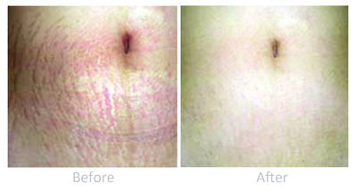 http://torontodermatologycentre.com/UserFiles/Image/imgdir_1/DR-stretch-mark-ba-.jpg