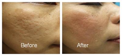 http://4.bp.blogspot.com/-dnpkKAOvzP4/Vex8swKQcNI/AAAAAAAAGfo/rG1FD6YA1RA/s640/derma%2Broller%2B5.jpg
