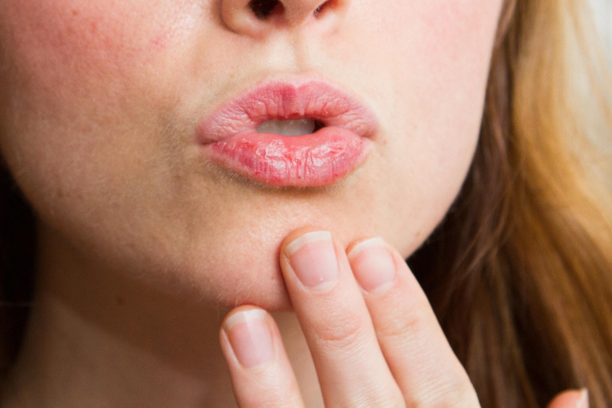 Bibir Kering Pecah Pecah Dan Perih Atasi Dengan DIY Lip Balm Yang