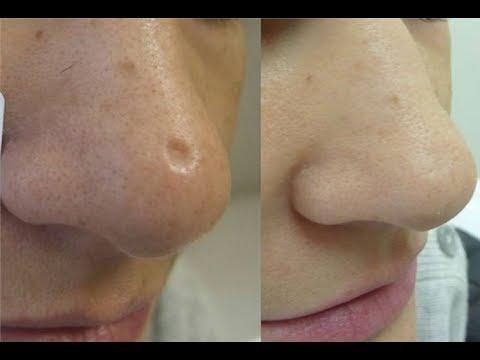 Cara menghilangkan bekas cacar air di wajah dengan cepat