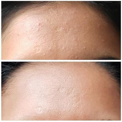 Kulit Berjerawat Bisa Jadi Kamu Terkena Fungal Acne, Apa Itu?