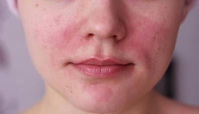 https://www.drkabra.com/images/acne-rosacea2.jpg